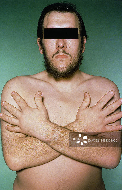 患有肢端肥大症的男子临床照片图片素材