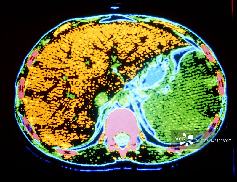 彩色CT扫描显示脾脏增大图片素材
