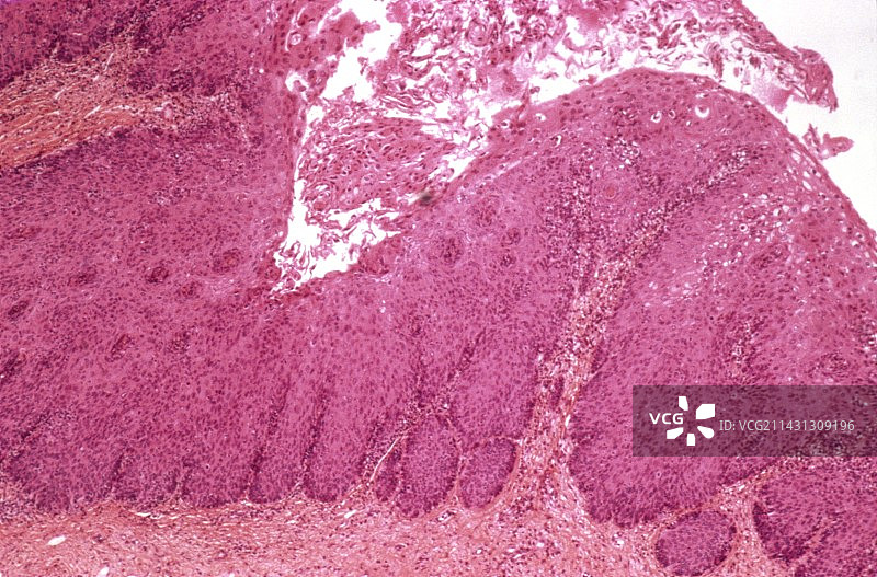 子宫内膜鳞状化生图片素材