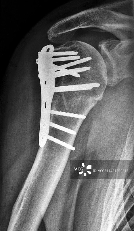 肱骨内固定X光片图片素材
