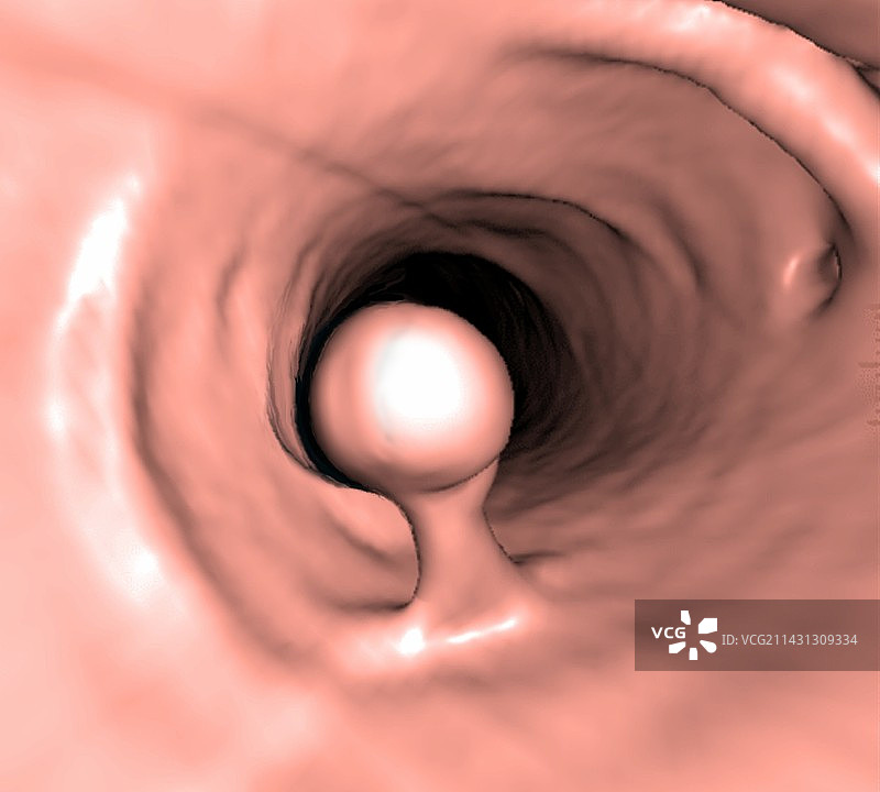 结直肠息肉3D CT扫描图片素材