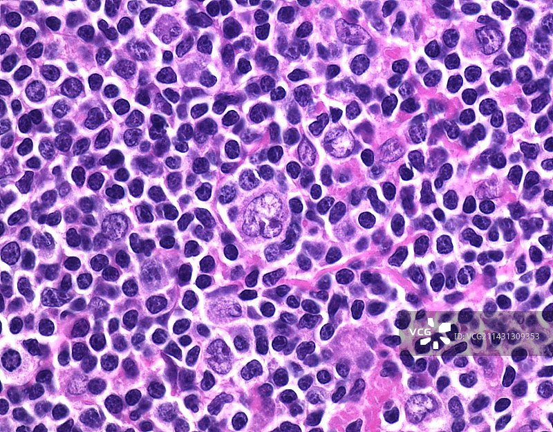 结节性淋巴细胞为主型霍奇金淋巴瘤显微照片图片素材