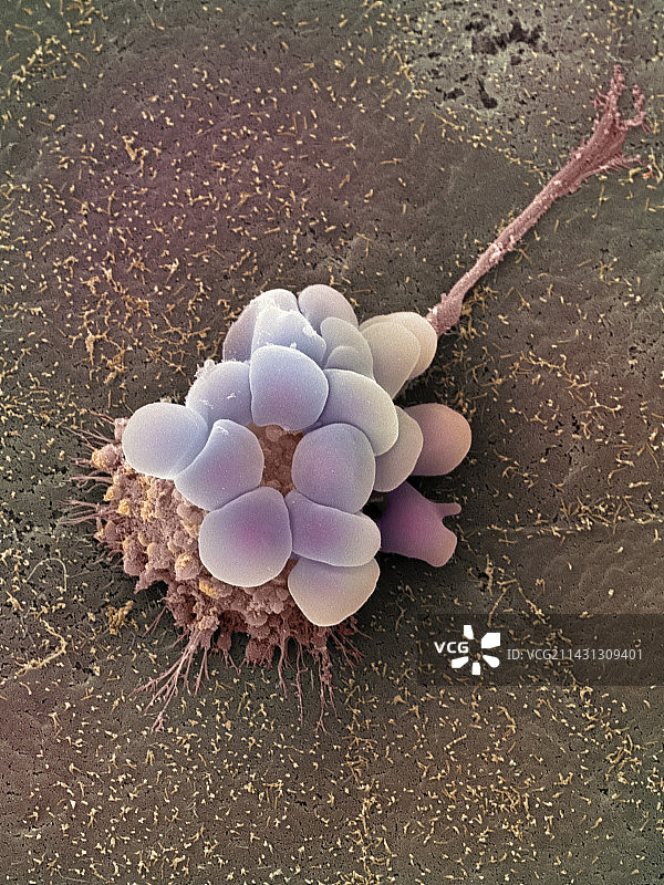 卵巢癌细胞扫描电镜图图片素材