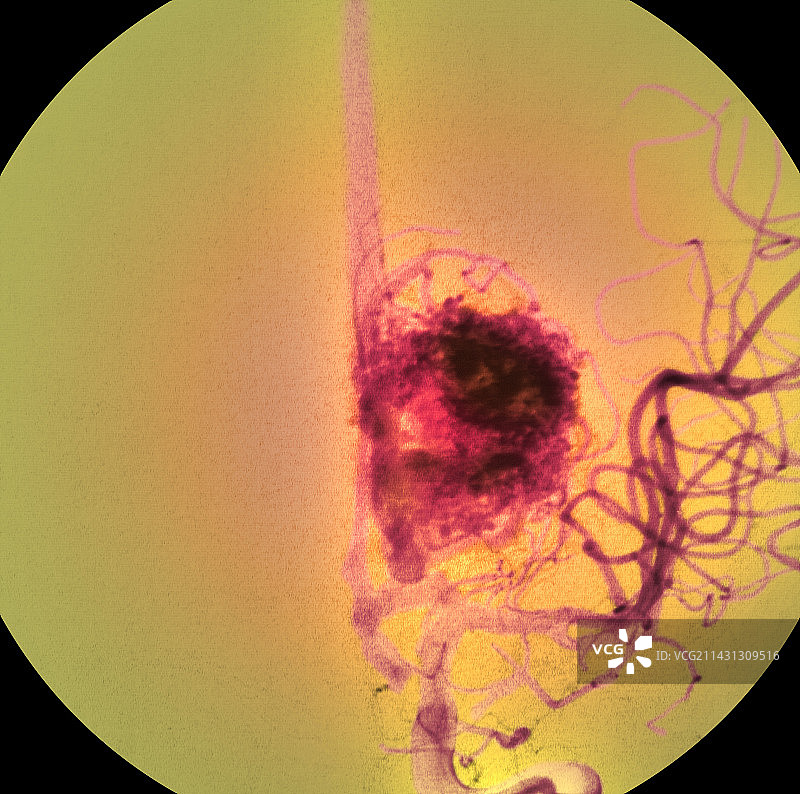 血管肿瘤图片素材