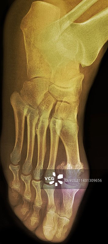 痛风足部X光片图片素材