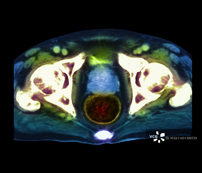 前列腺癌图片素材
