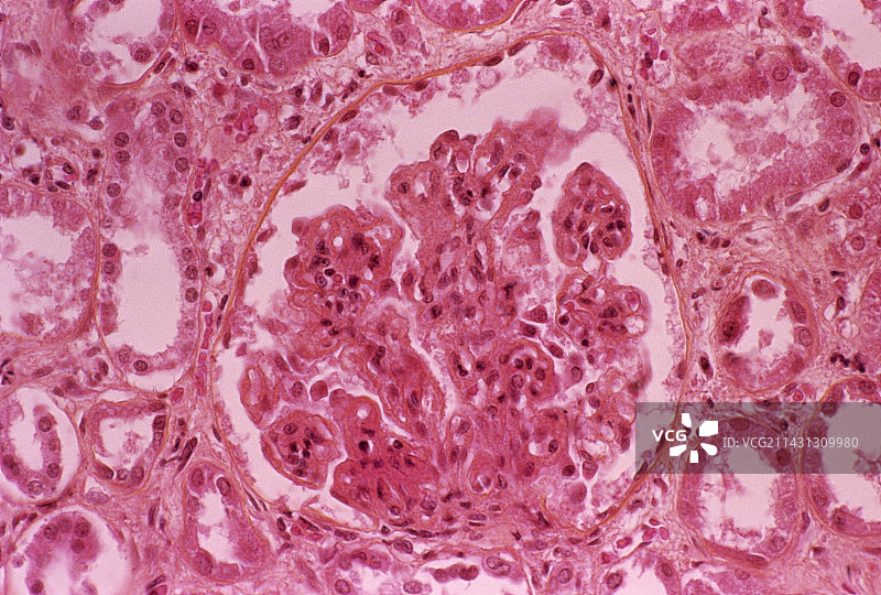免疫系统损伤的肾脏组织图片素材