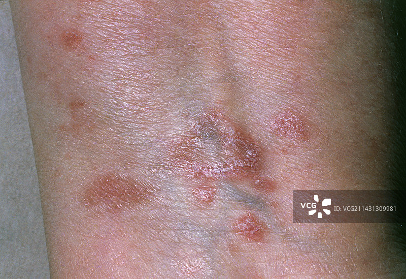 药物反应引起的地衣样皮疹图片素材
