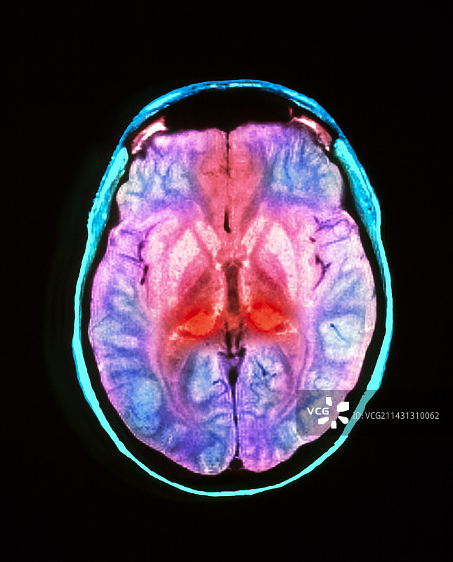 患有CJD的人脑核磁共振扫描图片素材