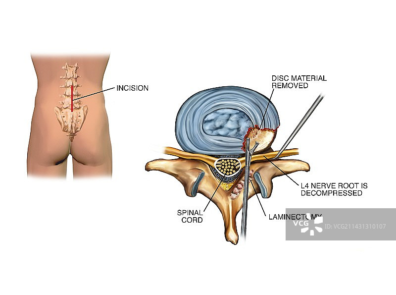椎板切除术治疗椎间盘突出图片素材