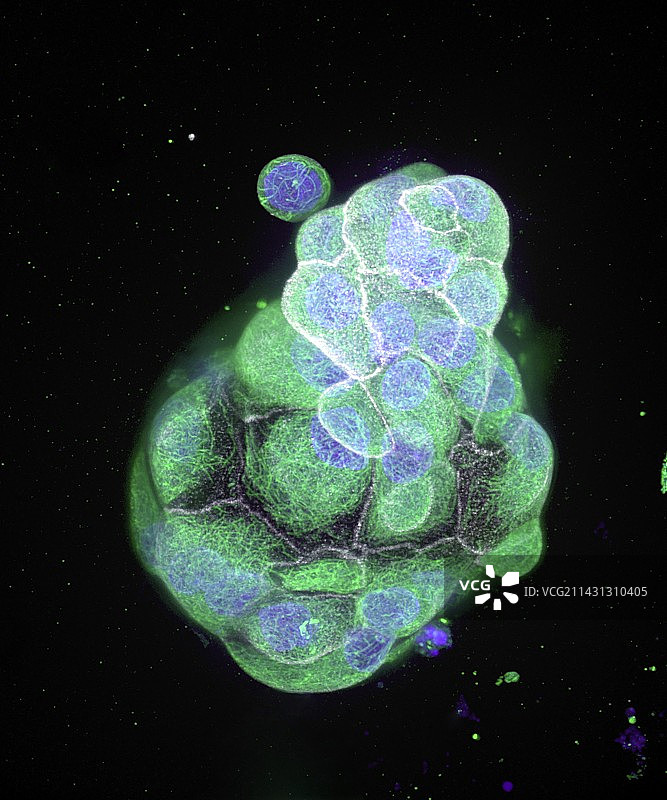 结肠癌细胞荧光显微照片图片素材