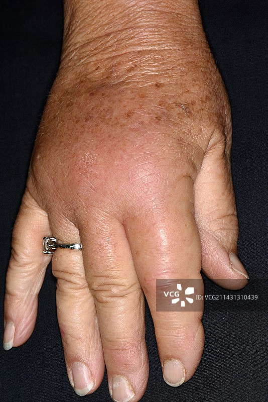 对蜜蜂叮咬的过敏反应图片素材