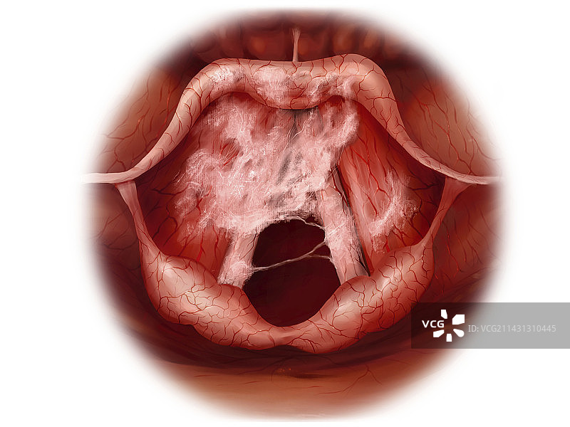 喉炎插图图片素材