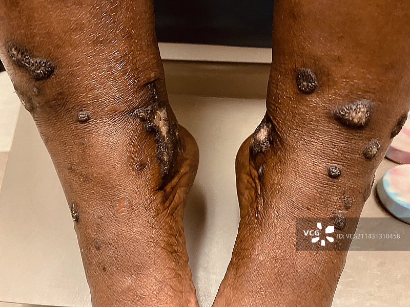 肥厚性扁平苔藓图片素材