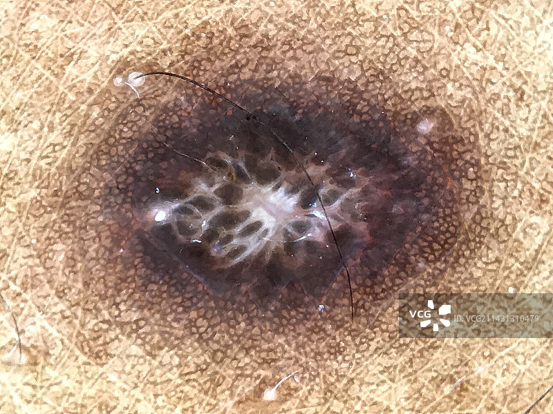 皮肤纤维瘤，皮肤镜检查图片素材