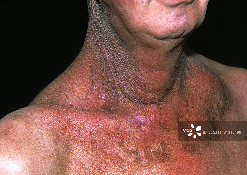 治疗后的咽喉癌图片素材