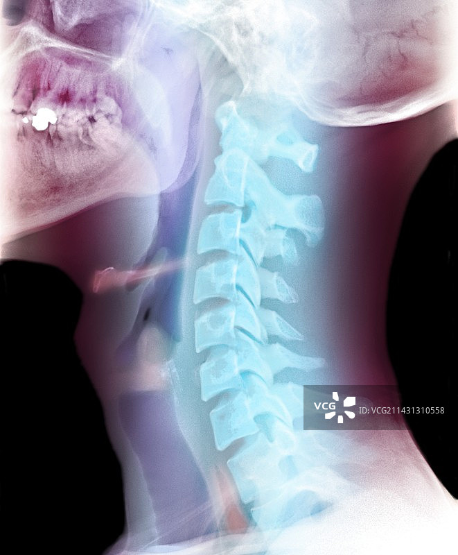 正常颈部X光片图片素材