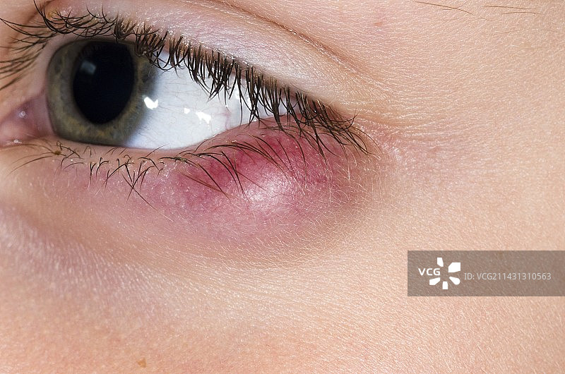 下眼睑的睑板腺囊肿图片素材