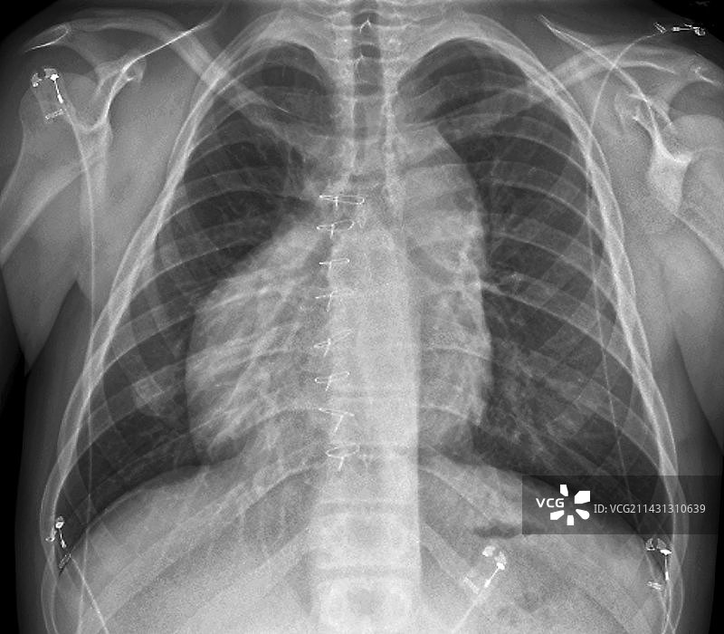 内脏反转X光片图片素材