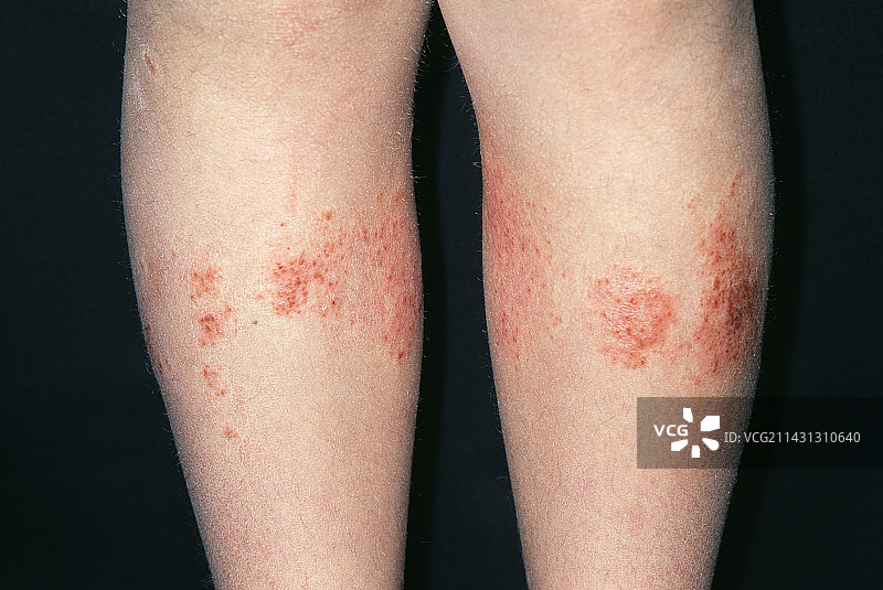 过敏性接触皮炎图片素材