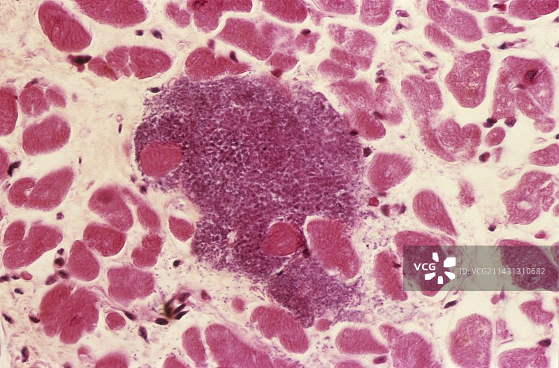 感染性心肌炎，光学显微照片图片素材