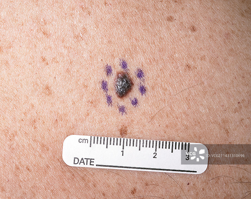 恶性黑色素瘤图片素材