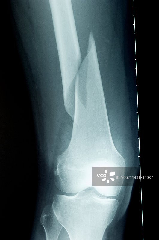 腿部股骨骨折X光片图片素材