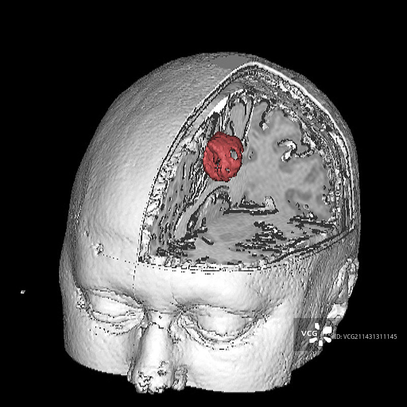 脑肿瘤3D核磁共振扫描图片素材