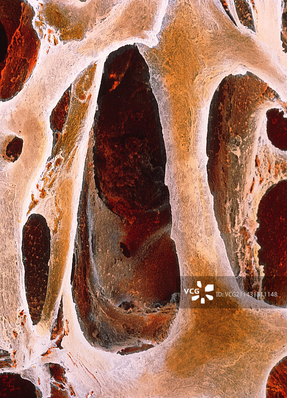 骨质疏松症中的松质骨图片素材
