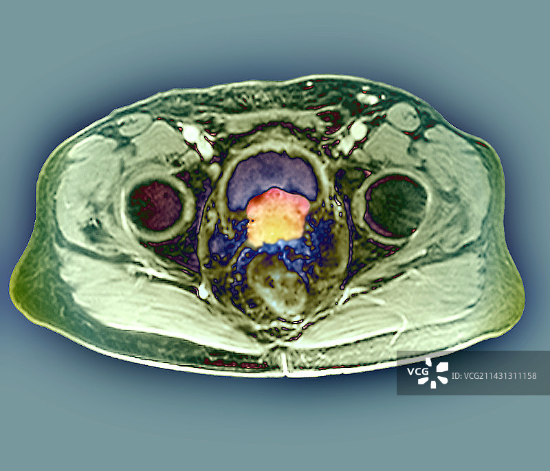 前列腺癌核磁共振扫描图片素材