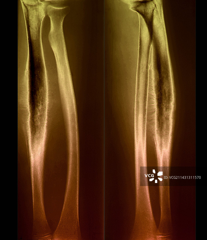 尤文氏肉瘤X光片图片素材