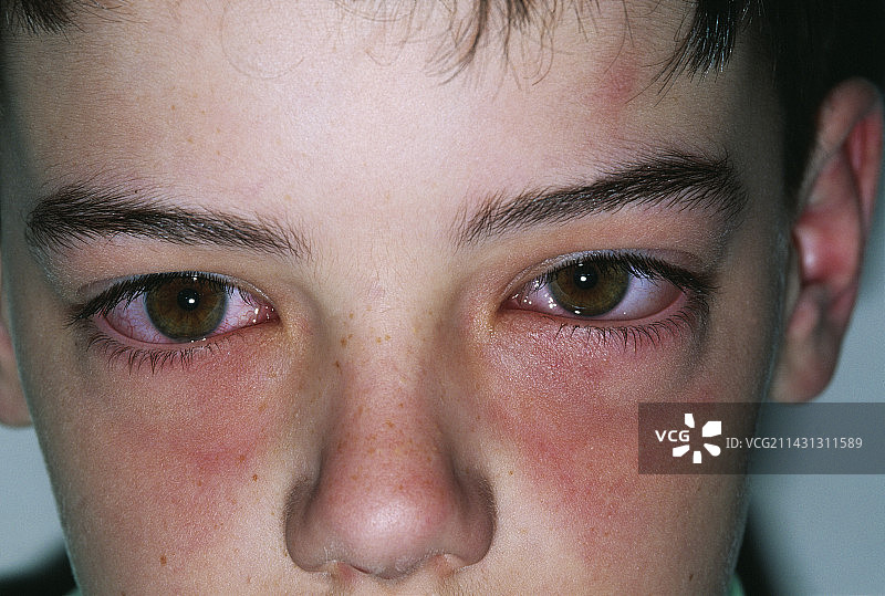 花粉热图片素材