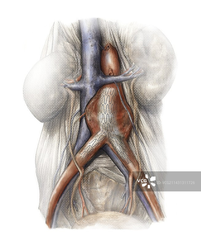 腹主动脉瘤图片素材