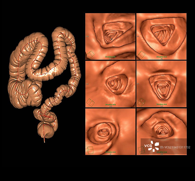 健康的结肠CT扫描图片素材