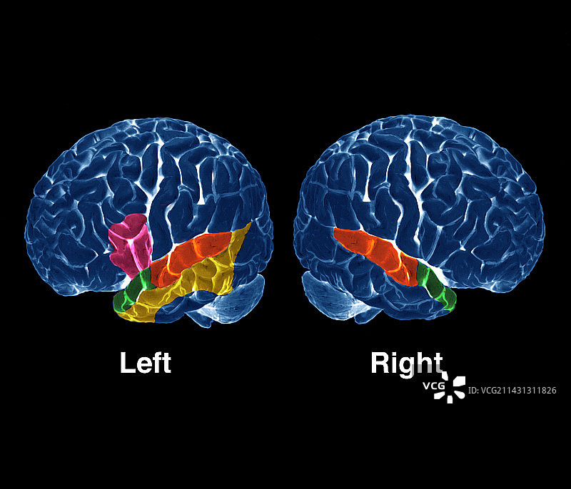 大脑听觉活动PET扫描图片素材