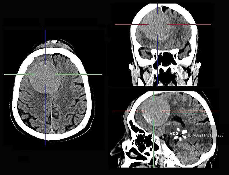 脑膜瘤脑癌CT扫描图片素材
