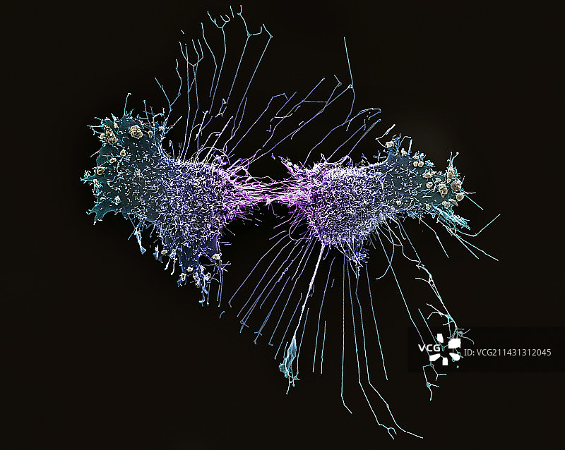 宫颈癌细胞分裂,扫描电镜图片素材