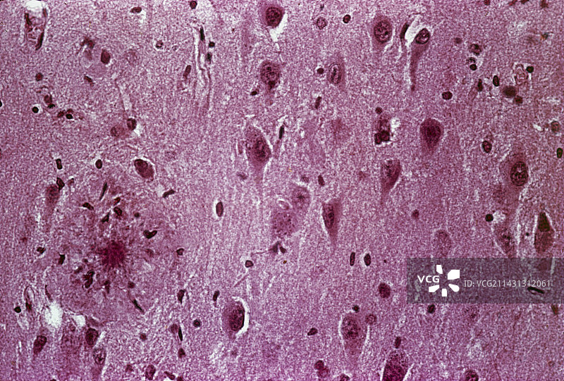 阿尔茨海默病脑组织图片素材