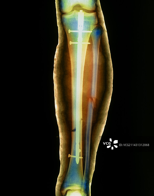 图钉固定的骨折腿部X光片图片素材