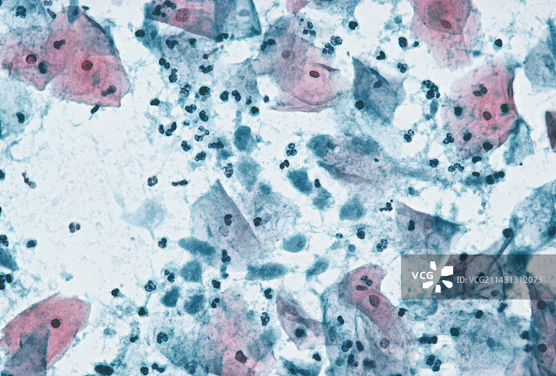 滴虫感染图片素材