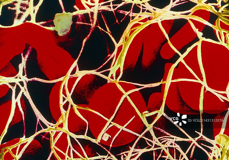 缠结在纤维蛋白中的红细胞彩色扫描电镜图像图片素材