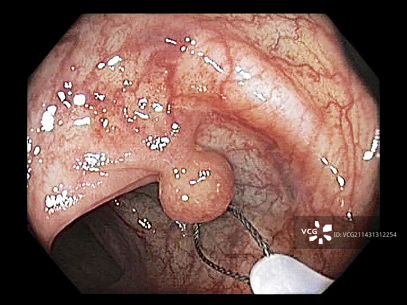 结肠增生性息肉，结肠镜图像图片素材