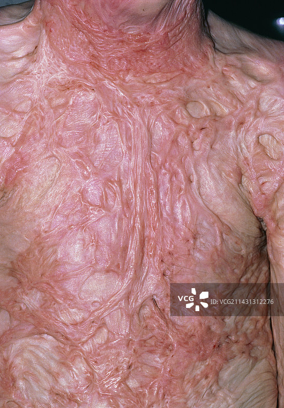 烧伤：9岁男孩胸部严重疤痕图片素材