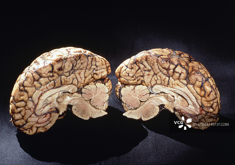 健康的对半切开的人脑（矢状切面）图片素材