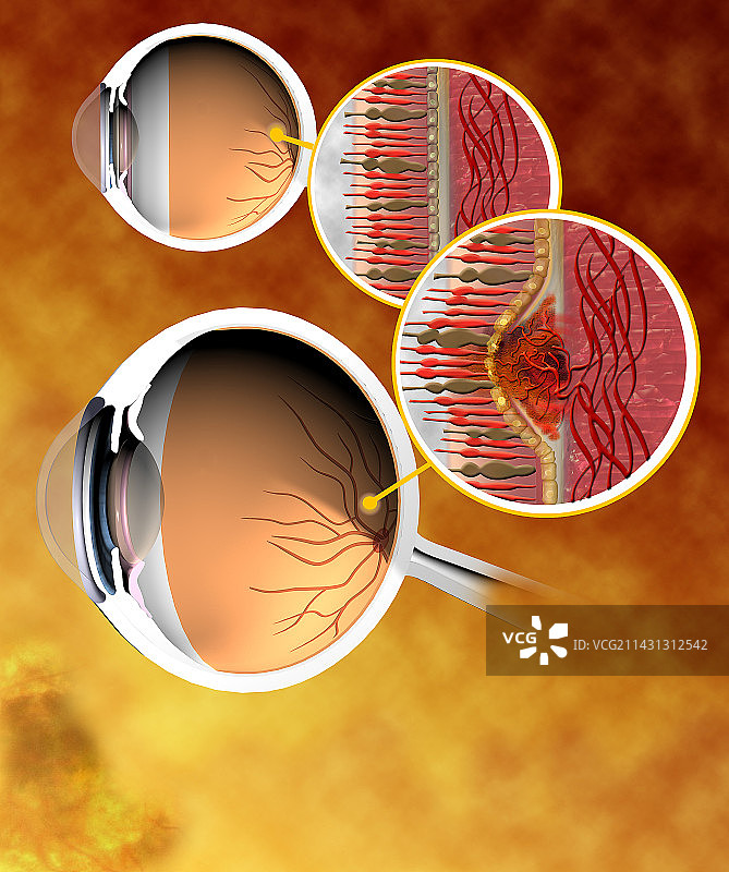 黄斑变性电脑艺术图图片素材