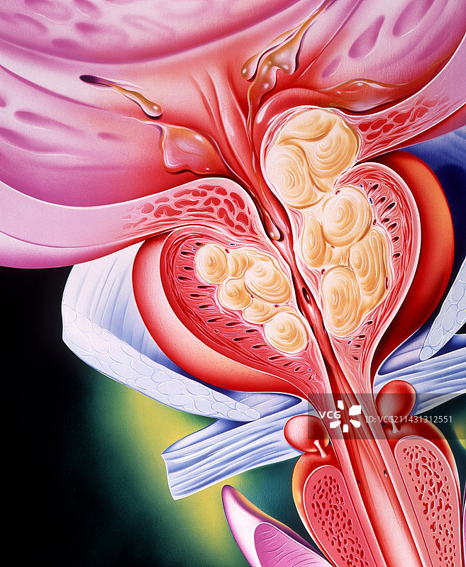 良性前列腺增生艺术作品图片素材