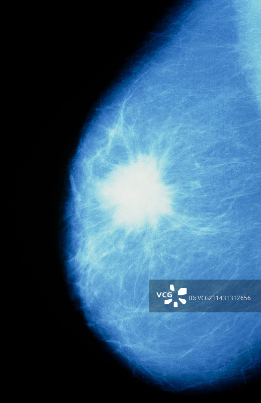 乳房X光检查：显示女性乳房中的癌性肿瘤图片素材