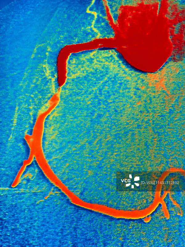 血管成形术前冠状动脉血管造影图片素材