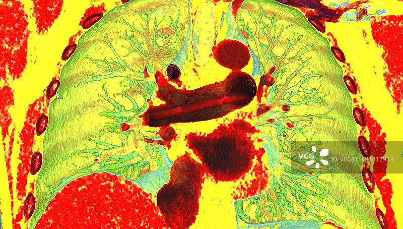 肺栓塞3D CT扫描图片素材