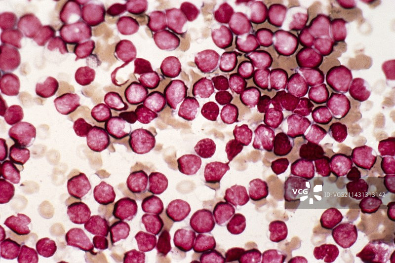 急性淋巴细胞白血病显微照片图片素材